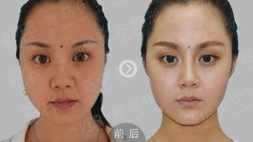 青岛伊美尔杨文国主任真实隆鼻案例 为什么有