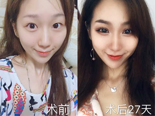 整形案例 青岛伊美尔5s双眼皮 27天蜕变大眼女神