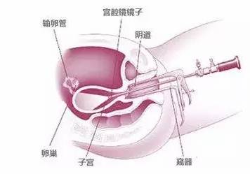 宫腔镜进入宫腔示意图