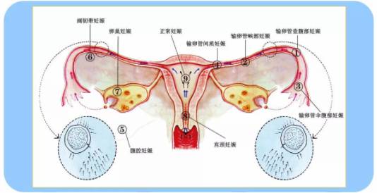 宫外孕随时破裂大出血!腹腔镜手术化险为夷 保"产"权