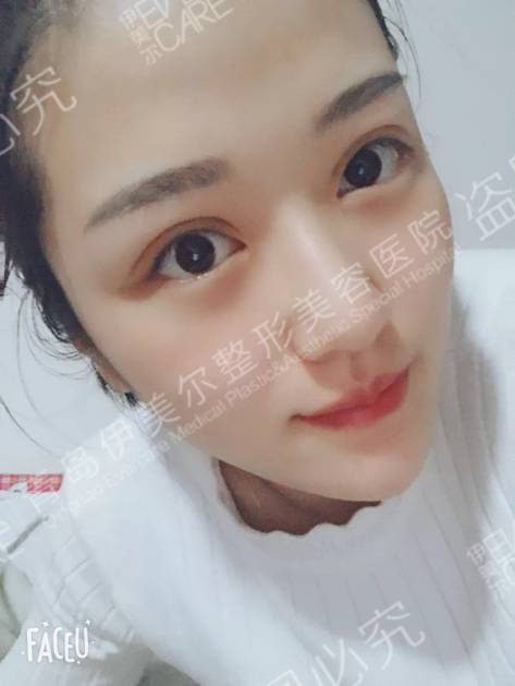 青岛伊美尔刘长发双眼皮日记 逆袭成女神就是这么简单