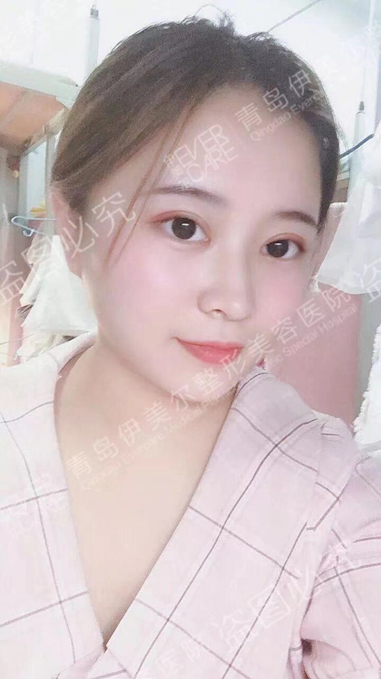 青岛伊美尔单文涛主任普通切开双眼皮 开眼角真实案例