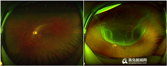 正常人群的眼底照相(左)与视网膜脱离患者的眼底照相(右)
