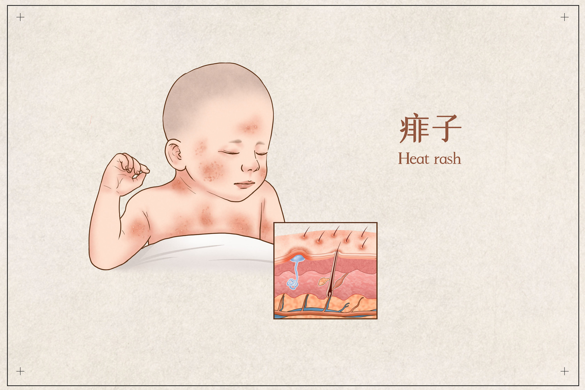 到底是新生儿痤疮还是湿疹，没有定论 | Exif_JPEG_PICTURE | 活到老学到老 | Flickr