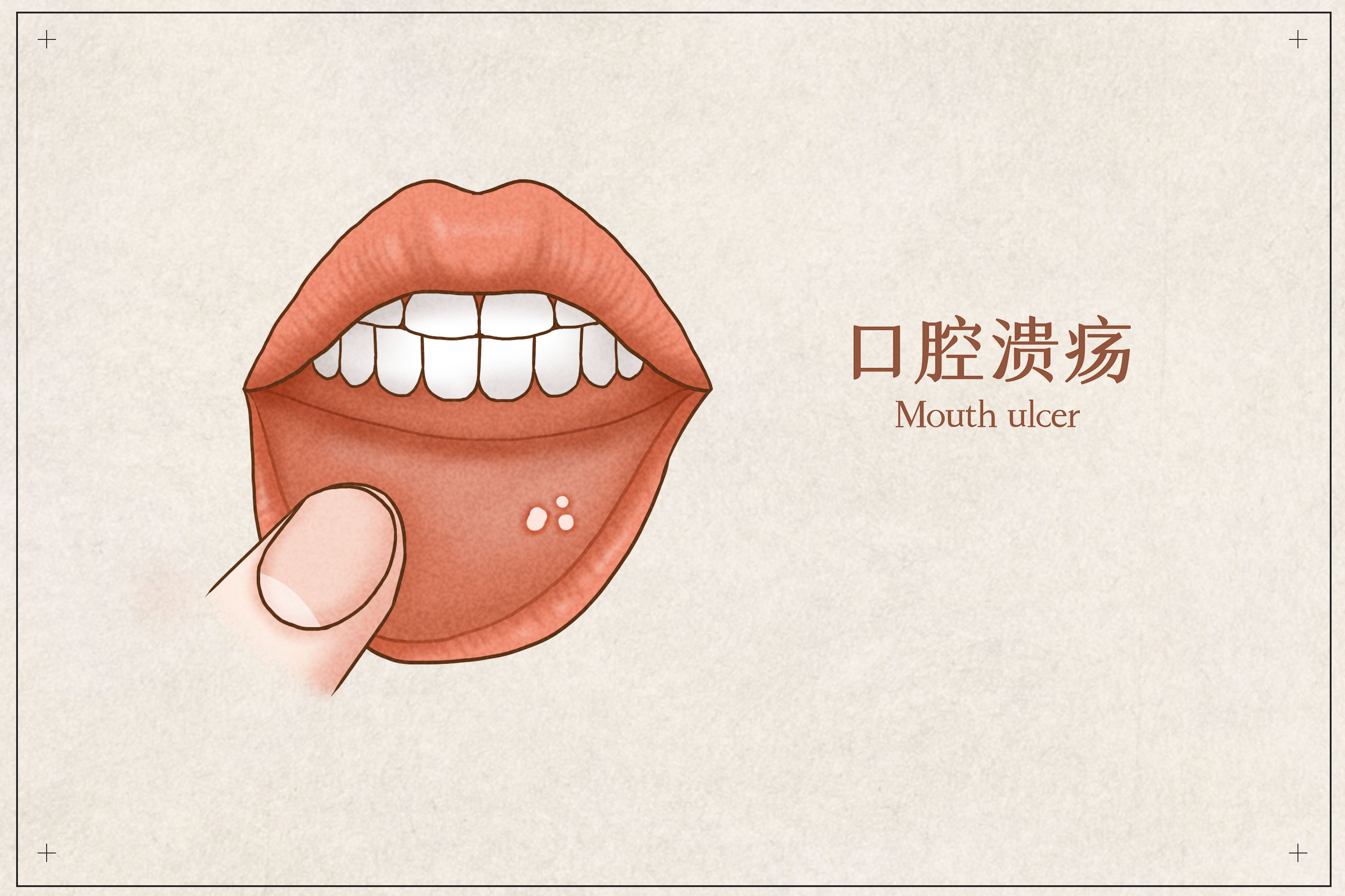 子供の口内炎の症状としては、唇や舌、口の中の頬の内側などにできます。