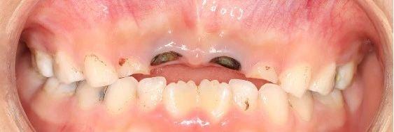 10岁男生乳牙坏成“小黑牙”只剩牙根，颌骨被大面积吸收......口腔专家提醒：乳牙龋坏危害多
