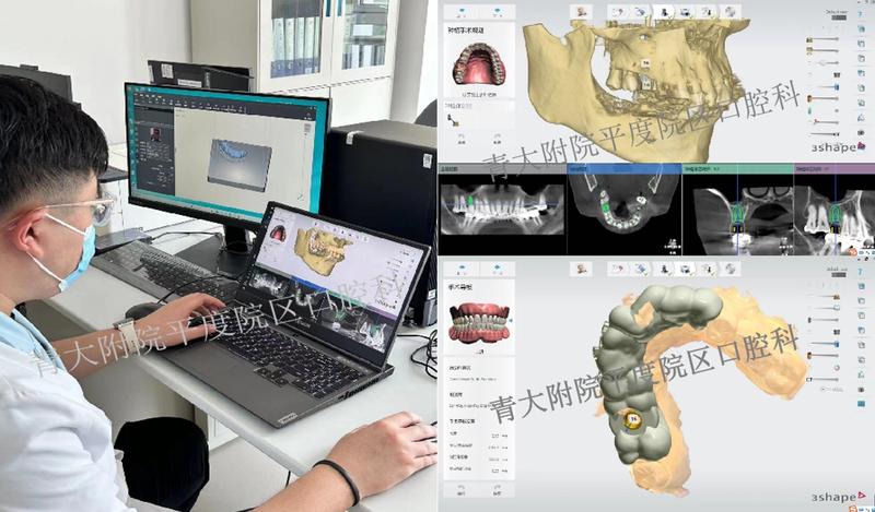 青大附院平度口腔科开展种植导板技术，大大提高种植手术的精准度和舒适度