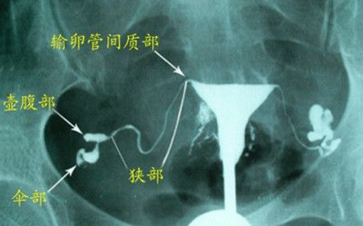 输卵管不孕怎么治