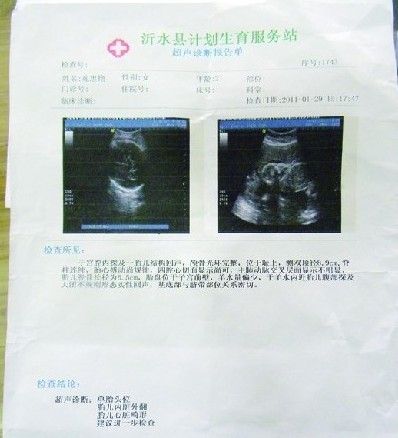 七次B超 李沧中心医院未查出胎儿畸形致死