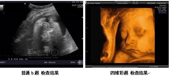 岛城首台美国ge专家版四维彩超落户新阳光医院