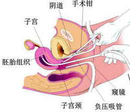 怀孕后不想要怎么办?