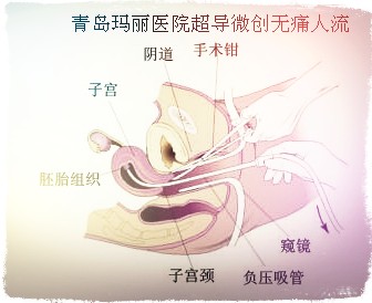 在青岛做无痛人流好不好?