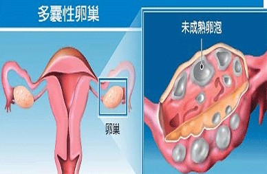 多囊卵巢引起的不孕在青岛怎么治?