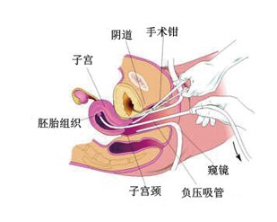 青岛妇产医院专家表示,无痛人流的收费情况主要由三部分组成,包括术前