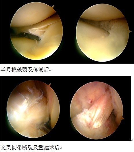 关节镜微创手术治疗膝关节内损伤 -青青岛