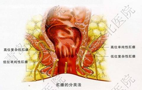 肛瘘的症状及治疗方法 青岛京北医院