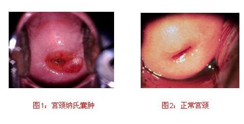 青岛纳氏囊肿怎么治-青岛新闻网