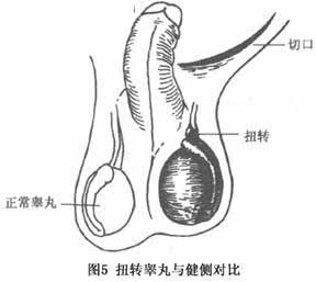 睾丸扭转的治疗