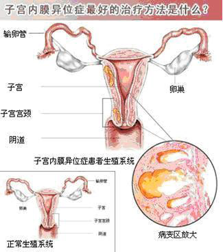 子宫内膜异位症的病因与治疗