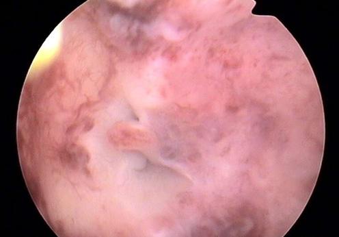 做人流什么时候合适