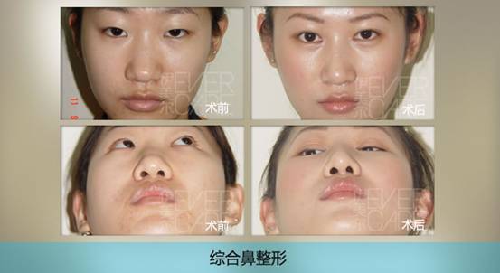 青岛隆鼻价格 最新2014年