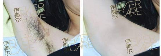 青岛永久脱毛需要多少钱