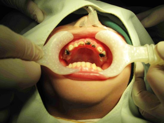 青岛市口腔医院儿童口腔科进入无痛、舒适治疗