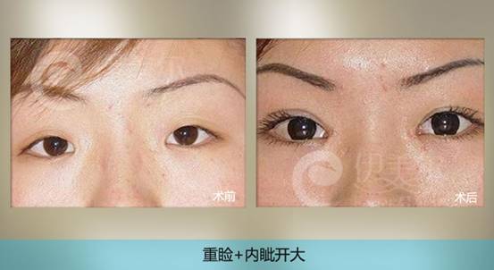 青岛眼睛整容多少钱