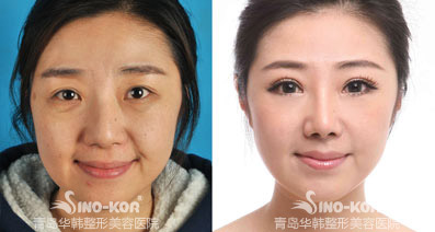 青岛华韩激光祛黄褐斑效果怎么样