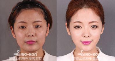 青岛华韩整形美容医院打瘦脸针好吗