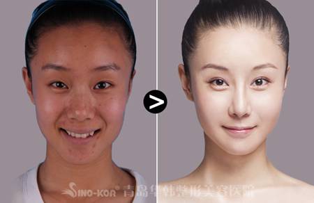 青岛激光嫩肤效果如何