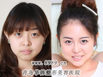 青岛华韩整形医院做埋线双眼皮多少钱