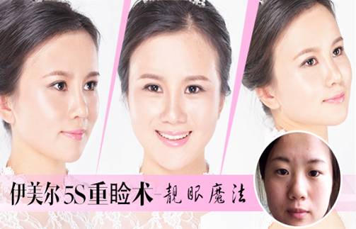 割双眼皮的费用是多少