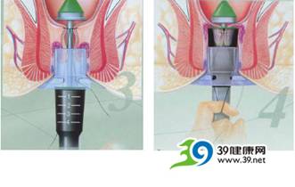 用药物治疗痔疮怎么样?