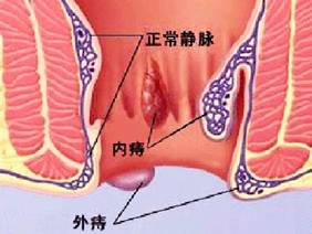 大便出血,如何区分痔疮还是肛裂?