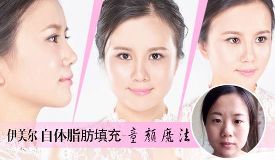 青岛自体脂肪填充除皱好不好