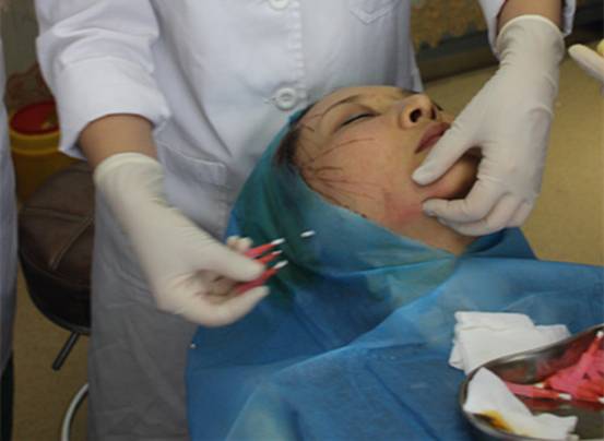 独家曝光线雕面部提拉那些不为人知的内幕!