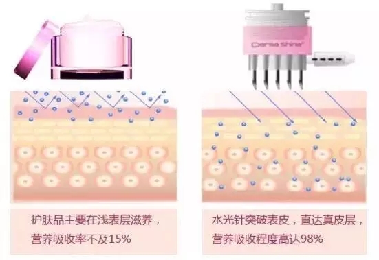 青岛液态超声刀伊美尔嗨体水光针