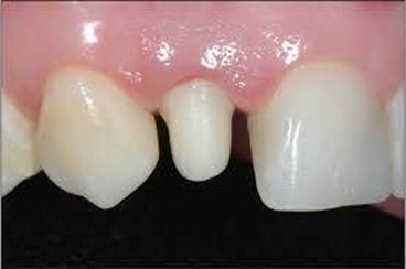 牙本质,而牙齿硬组织磨除后,是不能可逆再生的