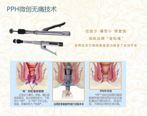 青岛医博肛肠医院 PPH微创无痛技术