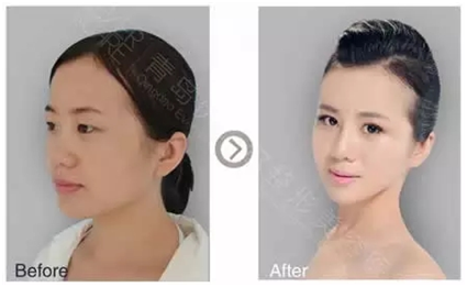 怎么快速练出下巴 38aa0a11-ec35-4dfd-a8ba-1b57d1c7356b.png