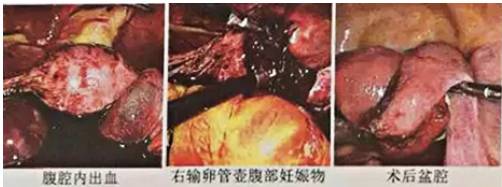 宫外孕随时破裂大出血!腹腔镜手术化险为夷 保"产"权