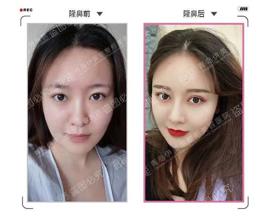 眼镜鼻梁怎么换,眼镜鼻梁托