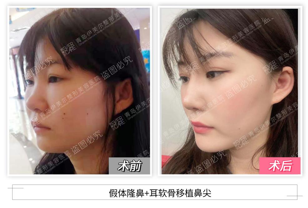 怎么让鼻子变得更美 21ea9ec3-1b53-4a18-9b0c-4f39af4bf087.jpg