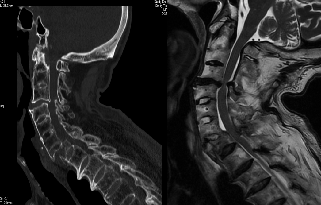 青医平度:脊柱扭成s形 脊柱畸形矫形手术助女孩重新挺直脊梁