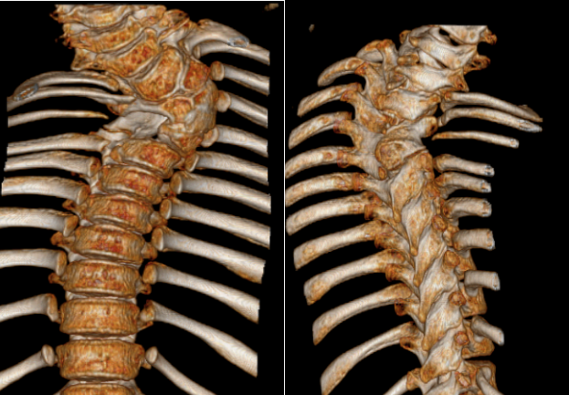 畸形胎儿脊柱弯曲图片