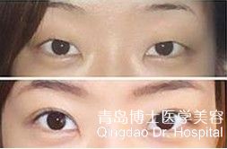割双眼皮排名_割双眼皮失败图片