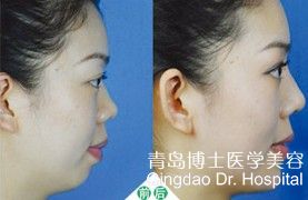 整形手术隆鼻多少钱 60a44c00a1b7132ded3826.jpg