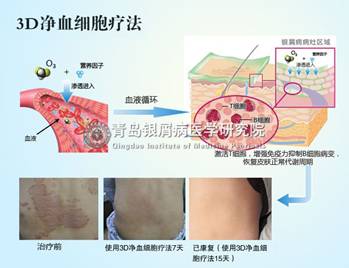 银屑病治疗医院排名_治疗银屑病的药膏图片(2)