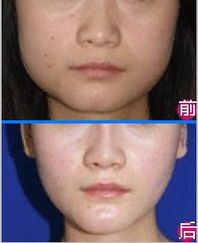 怎样瘦脸部两颊的肉 60a44c00a1b71773413324.jpg